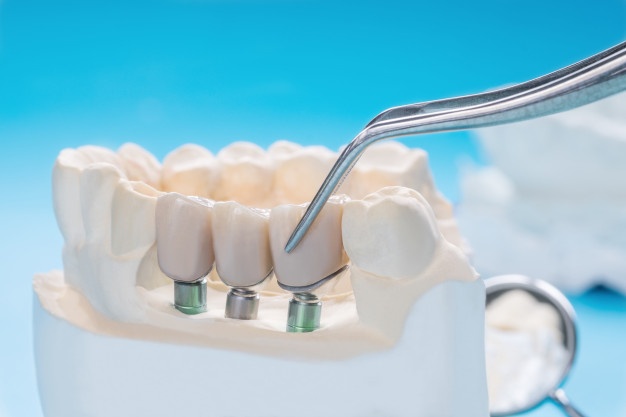 dental bridges longevity dentist cherry hill