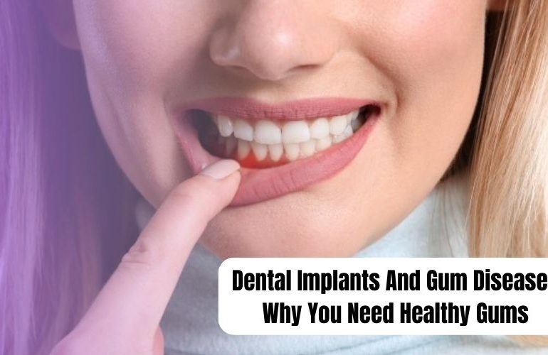 Dental Implants And Gum Disease