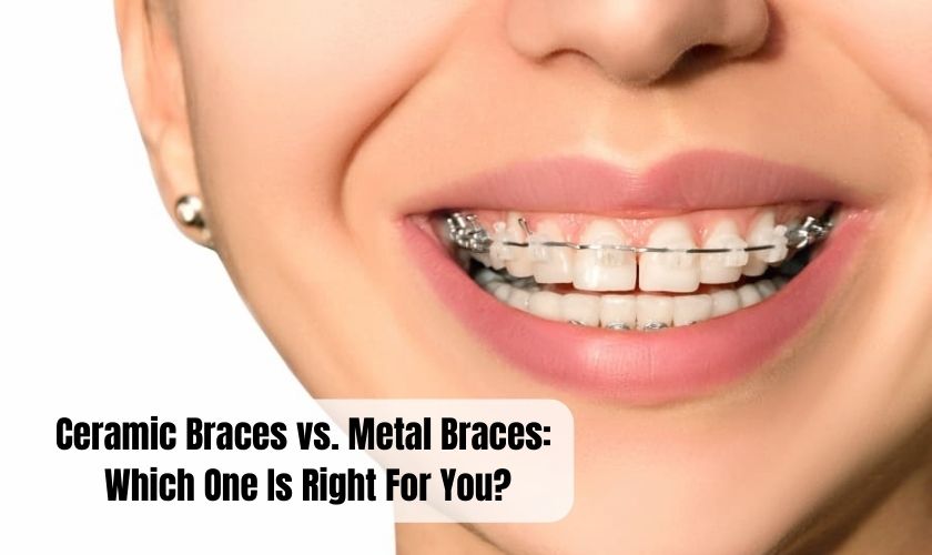 Ceramic Braces vs. Metal Braces